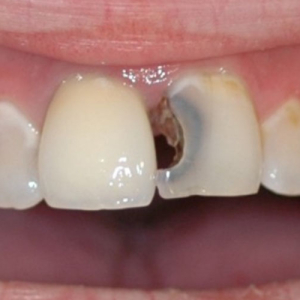 nut-rang-me-rang-co-nguy-hiem-khong-va-cach-phuc-hoi