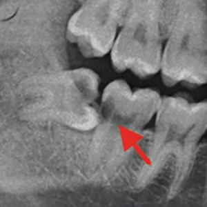 chi-phi-nho-rang-khon-bao-nhieu-bang-gia-moi-nhat-2025