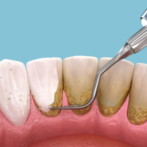 lay-cao-rang-va-tay-trang-rang-bi-quyet-cho-nu-cuoi-khoe-dep
