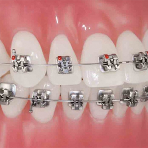 so-sanh-nieng-rang-mac-cai-kim-loai-thuong-va-nieng-rang-mac-cai-tu-buoc