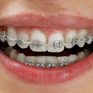 cac-phuong-phap-nieng-rang-pho-bien-tai-zen