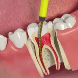 tam-quan-trong-cua-viec-dieu-tri-tuy-rang