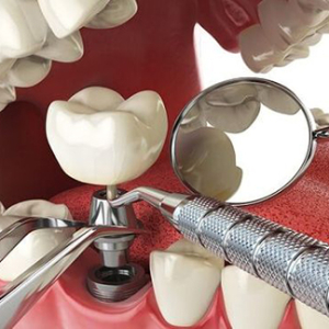 trong-rang-implant-la-gi-nhung-luu-y-khi-trong-rang-implant