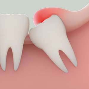 rang-khon-moc-lech-dau-hieu-nguyen-nhan-cach-xu-ly