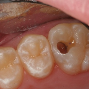 nguyen-nhan-bi-me-rang-ham-la-gi-cach-phuc-hoi-dung-cach