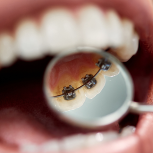 nieng-rang-mat-trong-mat-luoi-la-gi-uu-nhuoc-diem-va-chi-phi