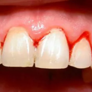 viem-loi-viem-nha-chu-nguyen-nhan-dau-hieu-va-cach-phong-ngua