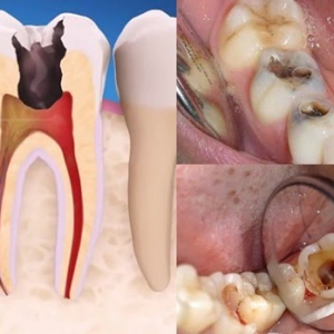 lay-tuy-rang-sua-co-can-thietkhong