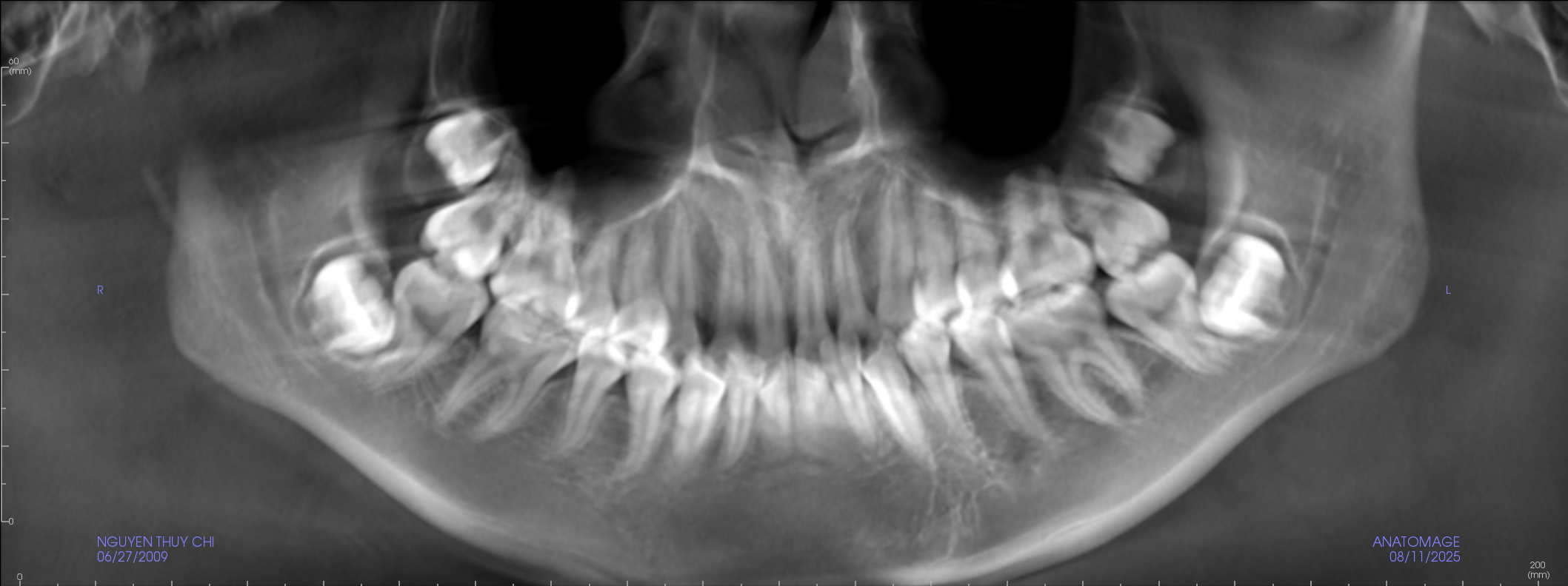 Nên khám răng định kỳ bao lâu một lần? Giải thích đầy đủ 4